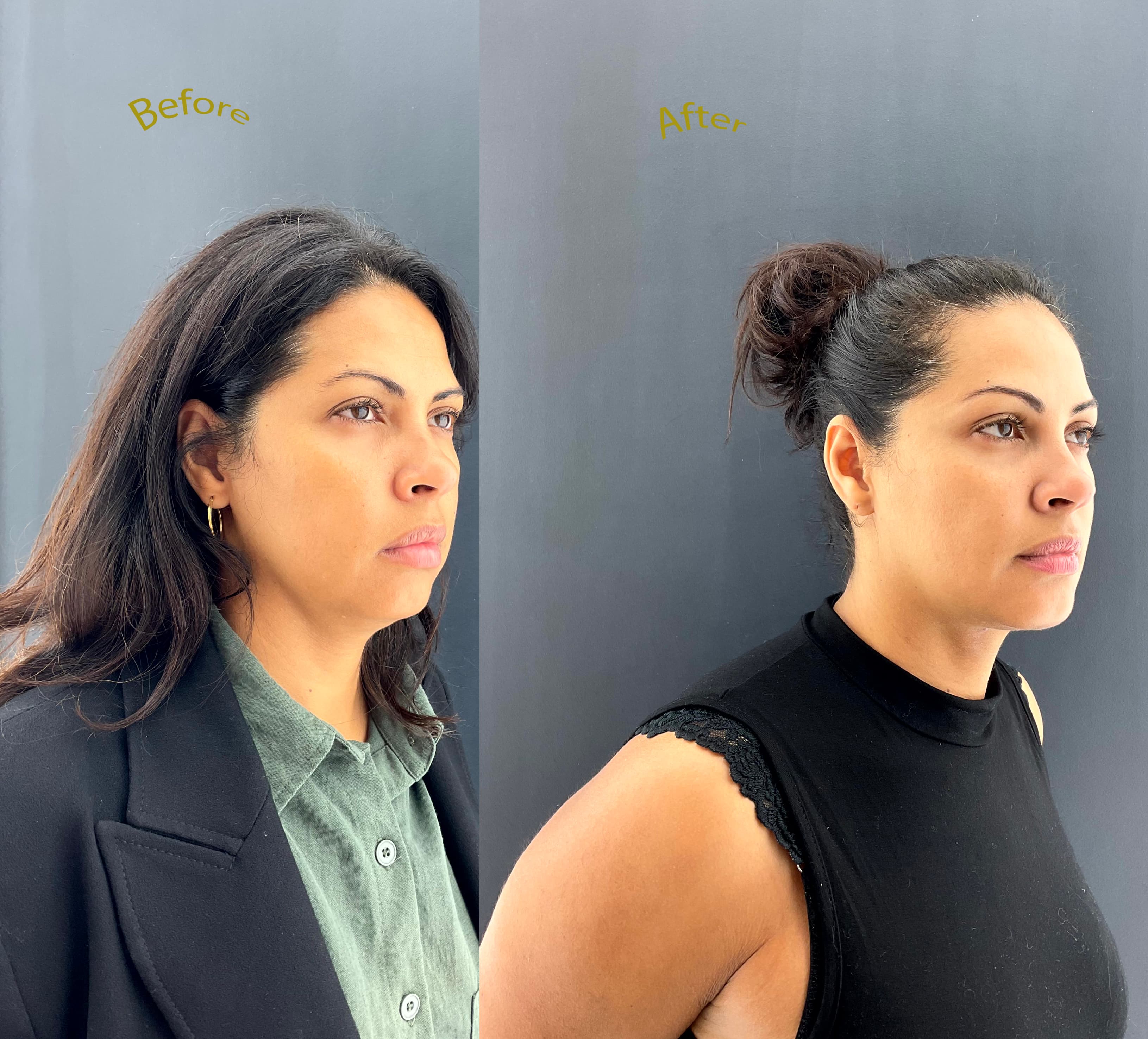 Published facial rejuvenation outcome image from Face of Athens