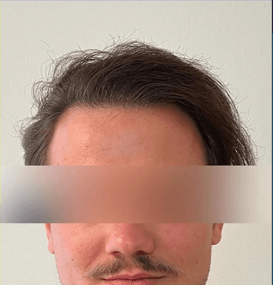 Published hair restoration outcome image from K-Hair Clinic