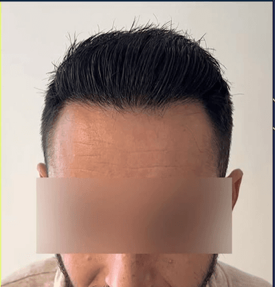 Second published hair restoration outcome image from K-Hair Clinic