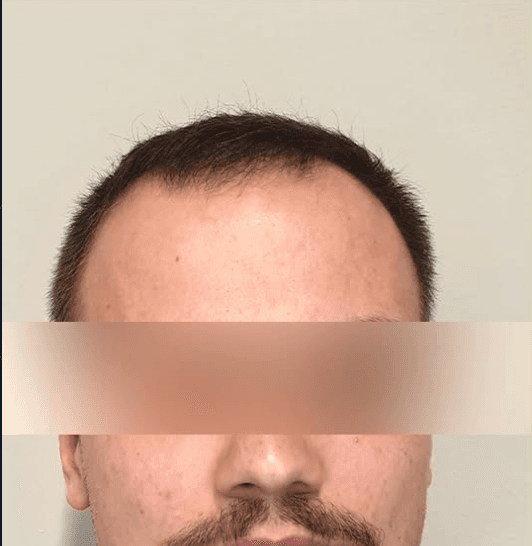 Published hair restoration source image from K-Hair Clinic